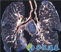 你知道什么是塵肺病嗎？使用粉塵儀可以降低塵肺病的發(fā)生率